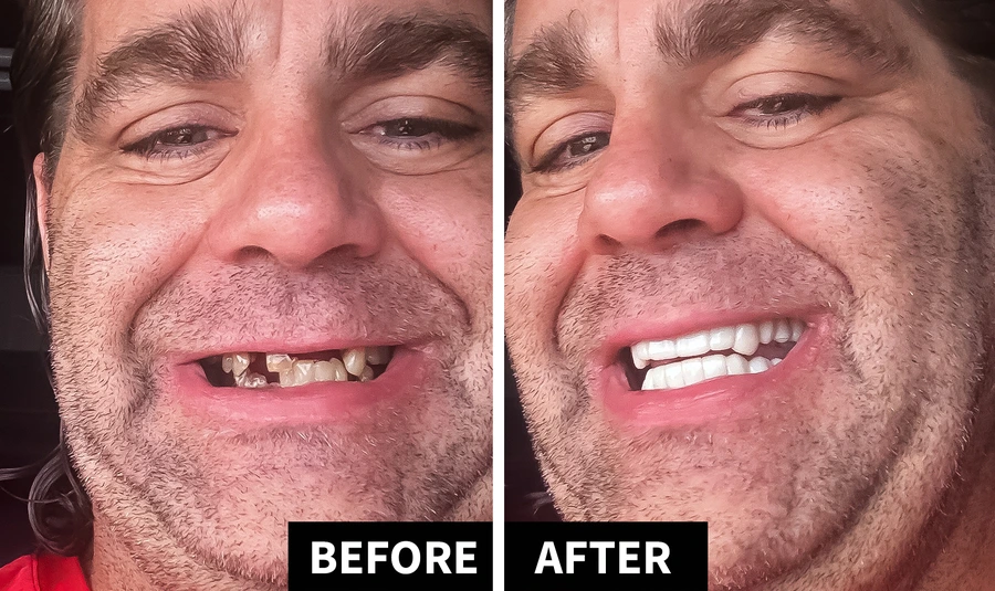 Snap On Veneers before and after showing teeth transformation with Shiny Smile veneers