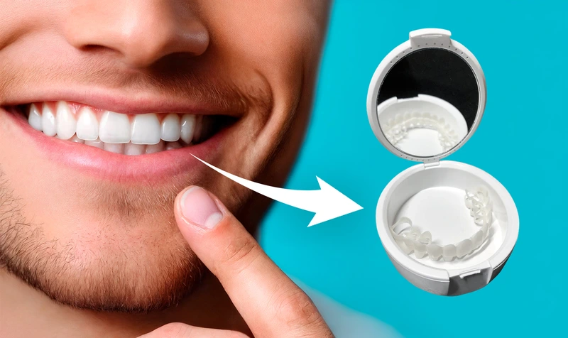 Person smiling while wearing Shiny Smile Snap On Veneers showing removable cosmetic veneers